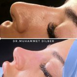 Burun Estetiği - Op. Dr. Muhammet Dilber